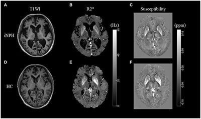 Assessing white matter microstructural changes in idiopathic normal pressure hydrocephalus using voxel-based R2* relaxometry analysis